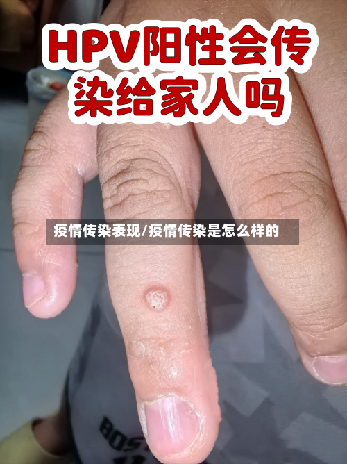 疫情传染表现/疫情传染是怎么样的-第2张图片