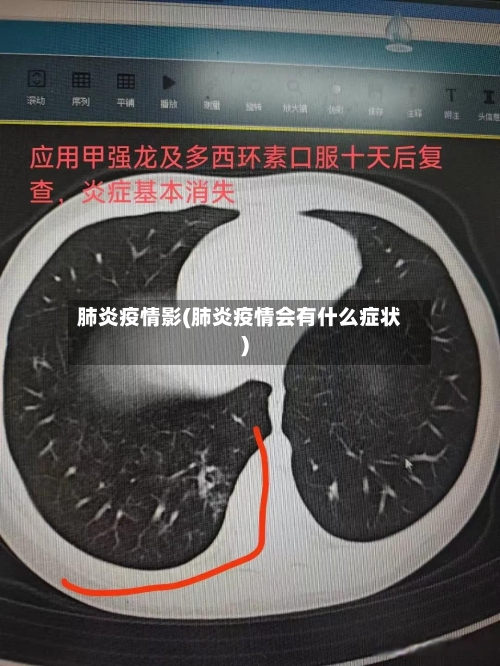 肺炎疫情影(肺炎疫情会有什么症状)-第2张图片