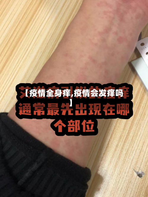 【疫情全身痒,疫情会发痒吗】-第1张图片